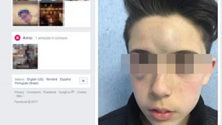 Napoli: 13enne aggredito da minorenni. I genitori pubblicano foto choc su Facebook